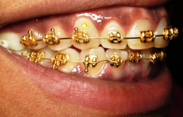 Gold-plated-braces